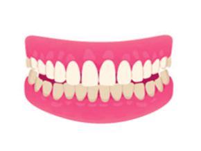 Overbite