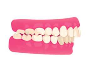 Overbite