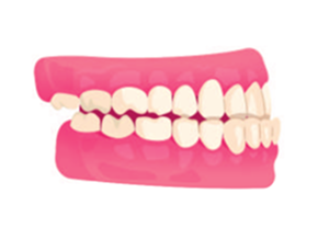 Underbite